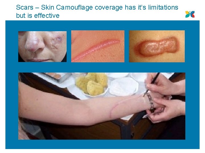 Scars – Skin Camouflage coverage has it’s limitations but is effective 