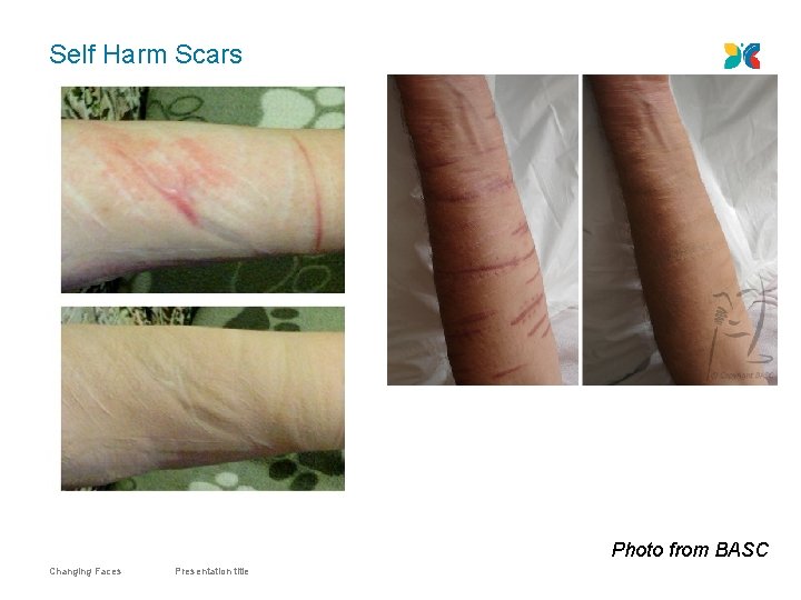 Self Harm Scars Photo from BASC Changing Faces Presentation title 