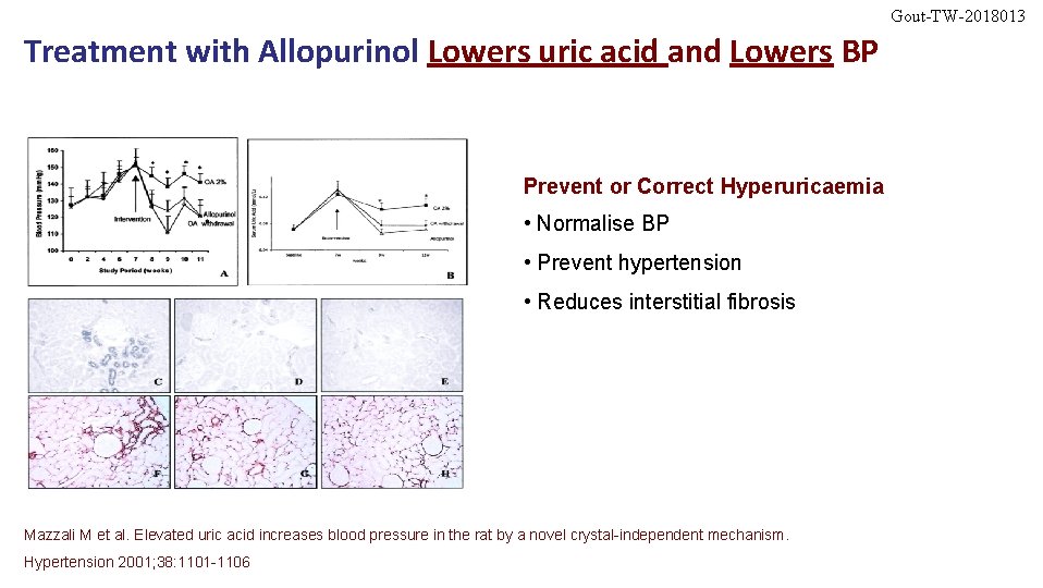 Gout-TW-2018013 Treatment with Allopurinol Lowers uric acid and Lowers BP Prevent or Correct Hyperuricaemia