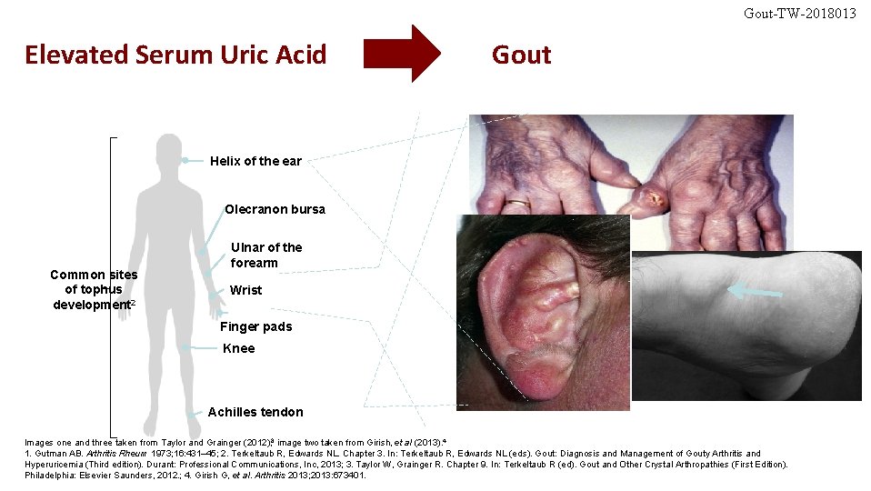 Gout-TW-2018013 Elevated Serum Uric Acid Gout Helix of the ear Olecranon bursa Common sites