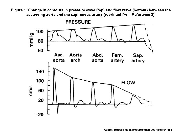 Figure 1. Change in contours in pressure wave (top) and flow wave (bottom) between Figure 1. Change in contours in pressure wave (top) and flow wave (bottom) between