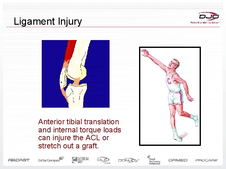 Ligament Injury Anterior tibial translation and internal torque loads can injure the ACL or