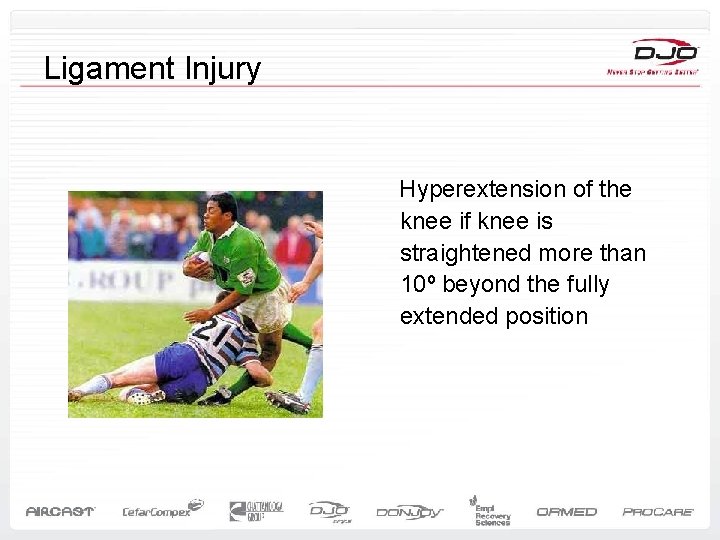 Ligament Injury Hyperextension of the knee if knee is straightened more than 10º beyond