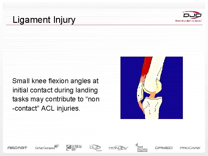 Ligament Injury Small knee flexion angles at initial contact during landing tasks may contribute