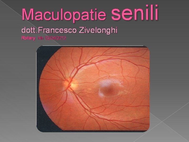 Maculopatie senili dott. Francesco Zivelonghi Rotary Mn 02/04/2012 