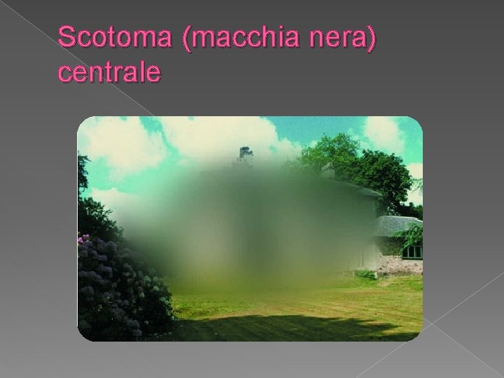 Scotoma (macchia nera) centrale 