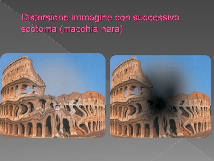 Distorsione immagine con successivo scotoma (macchia nera) 