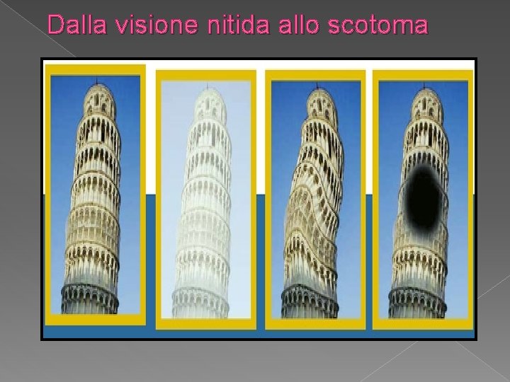 Dalla visione nitida allo scotoma 