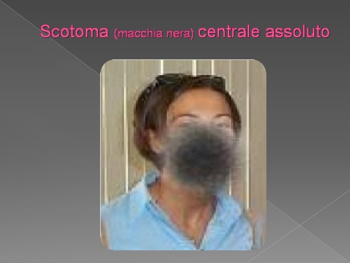 Scotoma (macchia nera) centrale assoluto 