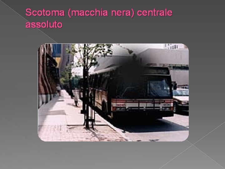 Scotoma (macchia nera) centrale assoluto 