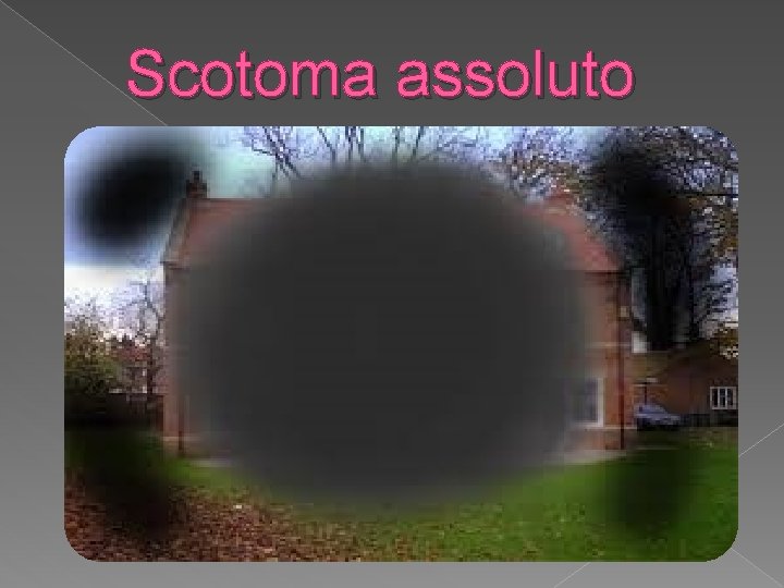 Scotoma assoluto 