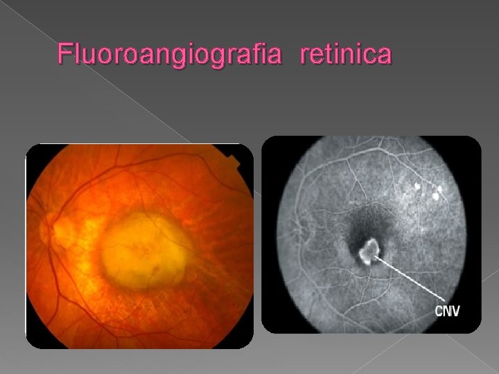Fluoroangiografia retinica 