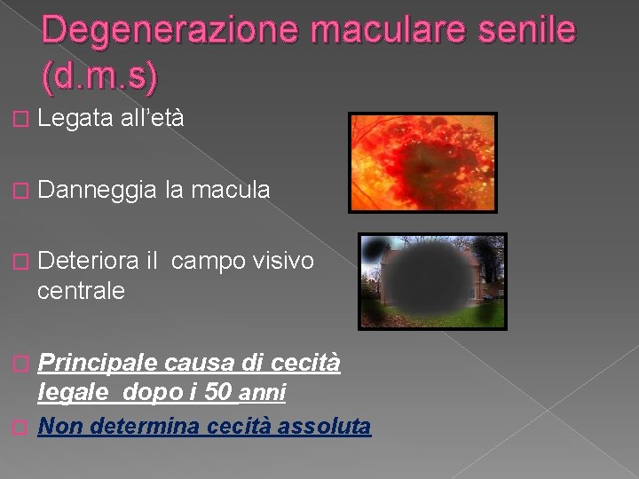 Degenerazione maculare senile (d. m. s) � Legata all’età � Danneggia la macula �