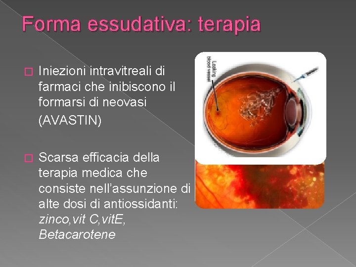 Forma essudativa: terapia � Iniezioni intravitreali di farmaci che inibiscono il formarsi di neovasi