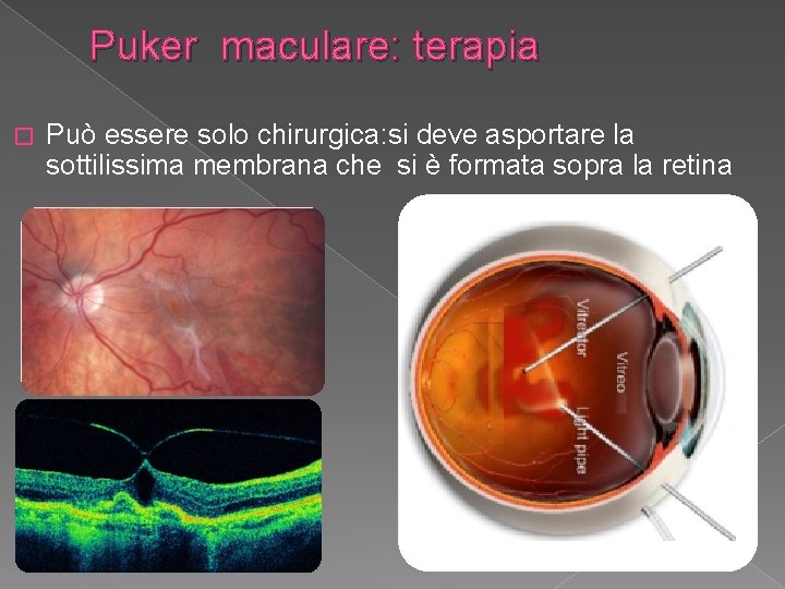 Puker maculare: terapia � Può essere solo chirurgica: si deve asportare la sottilissima membrana