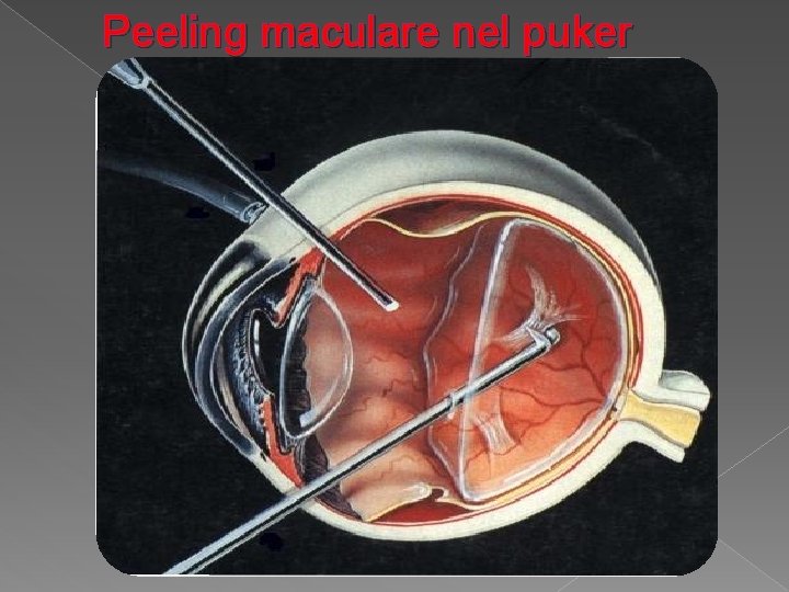 Peeling maculare nel puker 