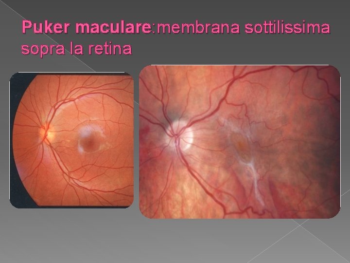 Puker maculare: membrana sottilissima sopra la retina 