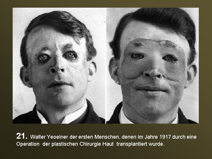 21. Walter Yeoeiner der ersten Menschen, denen im Jahre 1917 durch eine Operation der