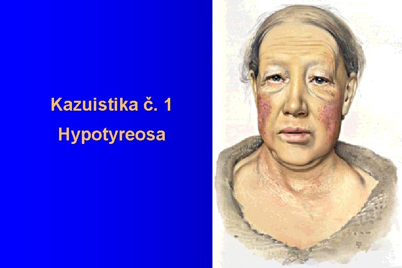 Kazuistika č. 1 Hypotyreosa 