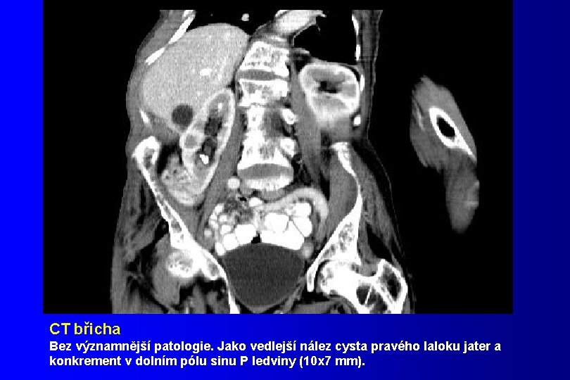 CT břicha Bez významnější patologie. Jako vedlejší nález cysta pravého laloku jater a konkrement