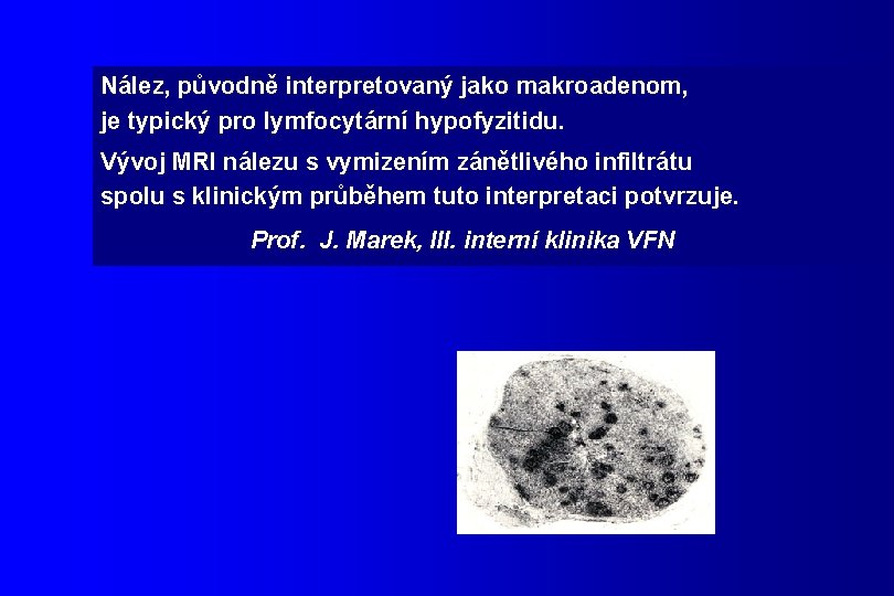 Nález, původně interpretovaný jako makroadenom, je typický pro lymfocytární hypofyzitidu. Vývoj MRI nálezu s