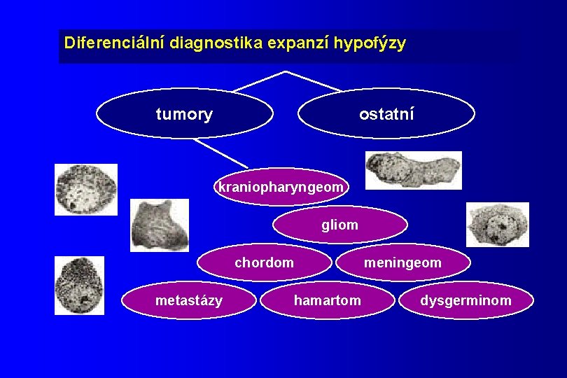 Diferenciální diagnostika expanzí hypofýzy tumory ostatní kraniopharyngeom gliom chordom metastázy hamartom meningeom dysgerminom 
