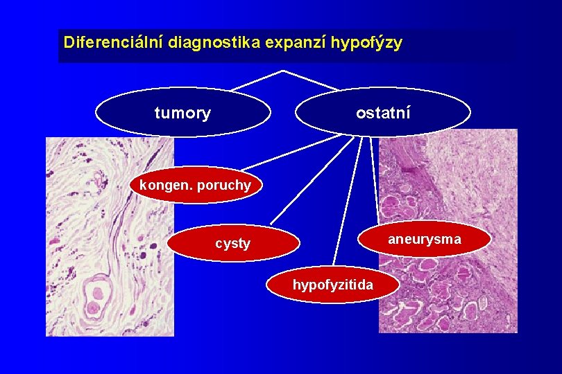 Diferenciální diagnostika expanzí hypofýzy tumory ostatní kongen. poruchy aneurysma cysty hypofyzitida 