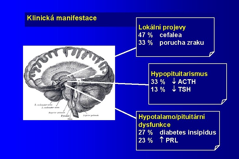 Klinická manifestace Lokální projevy 47 % cefalea 33 % porucha zraku Hypopituitarismus 33 %