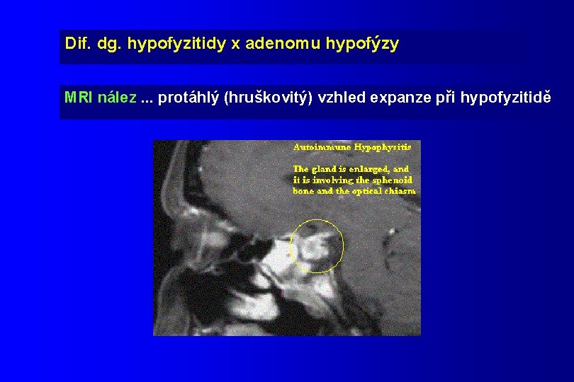 Dif. dg. hypofyzitidy x adenomu hypofýzy MRI nález. . . protáhlý (hruškovitý) vzhled expanze