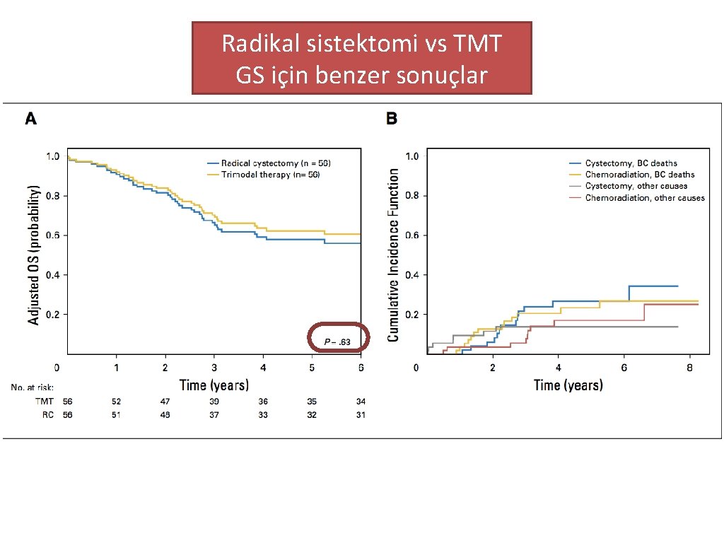 Radikal sistektomi vs TMT GS için benzer sonuçlar 