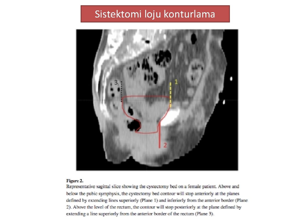 Sistektomi loju konturlama 