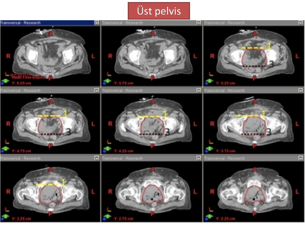 Üst pelvis 