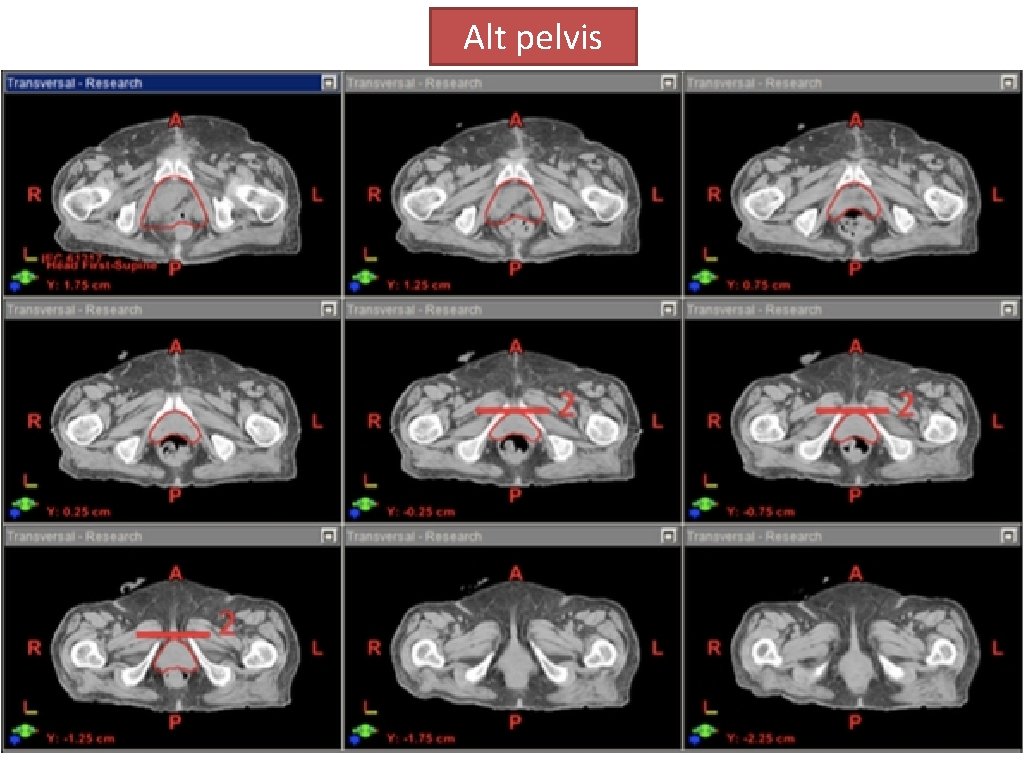 Alt pelvis 