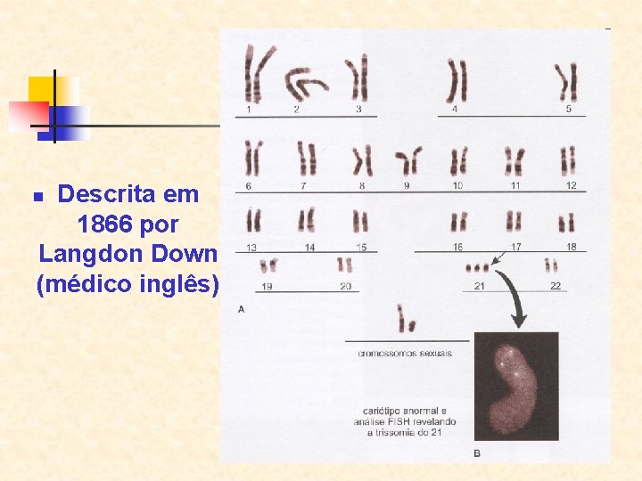 Descrita em 1866 por Langdon Down (médico inglês) n 