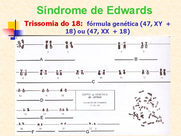 Síndrome de Edwards Trissomia do 18: fórmula genética (47, XY + 18) ou (47,