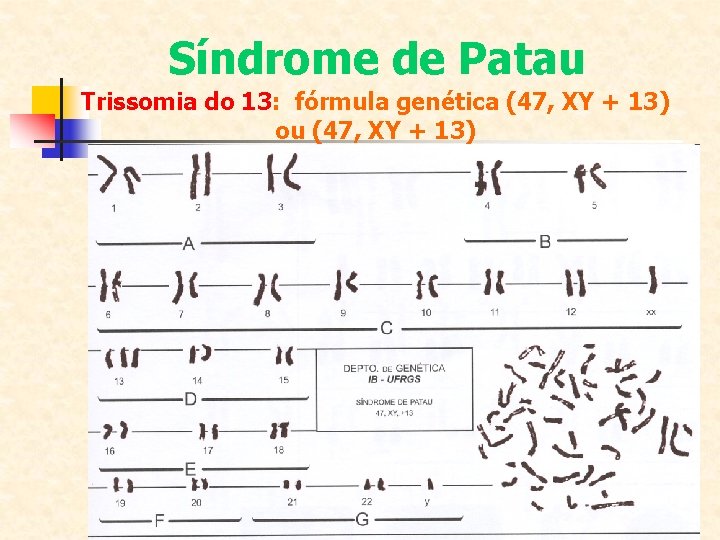 Síndrome de Patau Trissomia do 13: fórmula genética (47, XY + 13) ou (47,