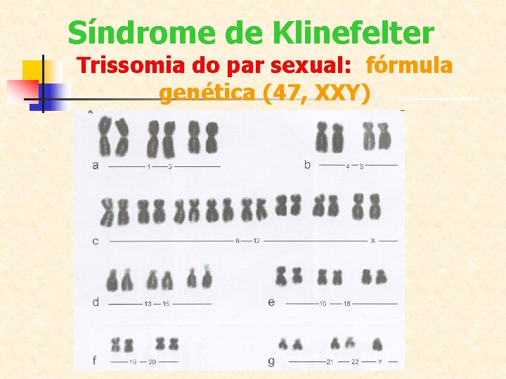 Síndrome de Klinefelter Trissomia do par sexual: fórmula genética (47, XXY) 