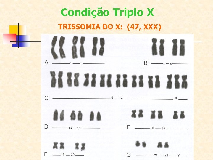 Condição Triplo X TRISSOMIA DO X: (47, XXX) 