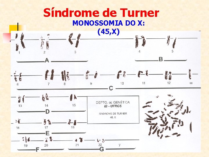 Síndrome de Turner MONOSSOMIA DO X: (45, X) 