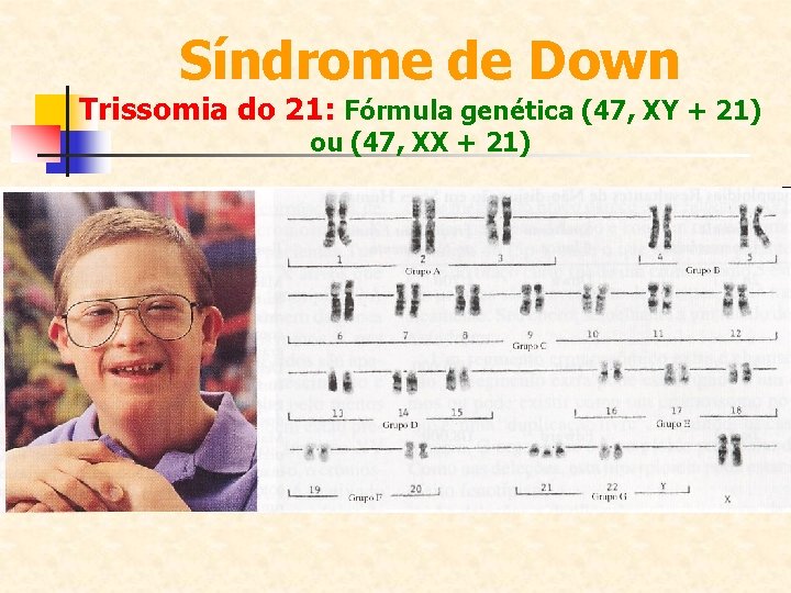 Síndrome de Down Trissomia do 21: Fórmula genética (47, XY + 21) ou (47,