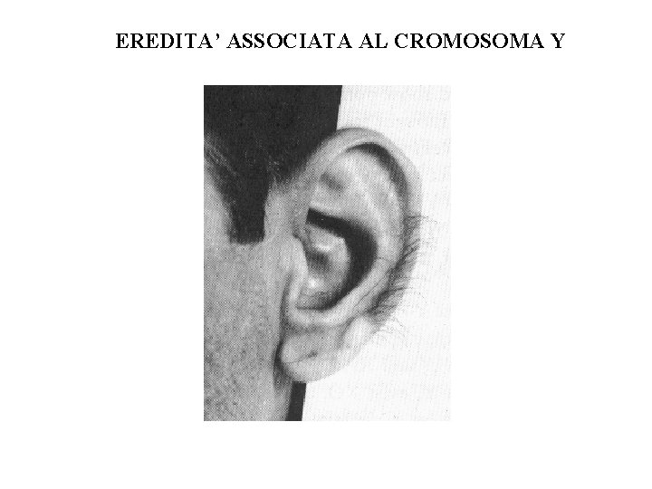 EREDITA’ ASSOCIATA AL CROMOSOMA Y EREDITA’ ASSOCIATA AL CROMOSOMA Y