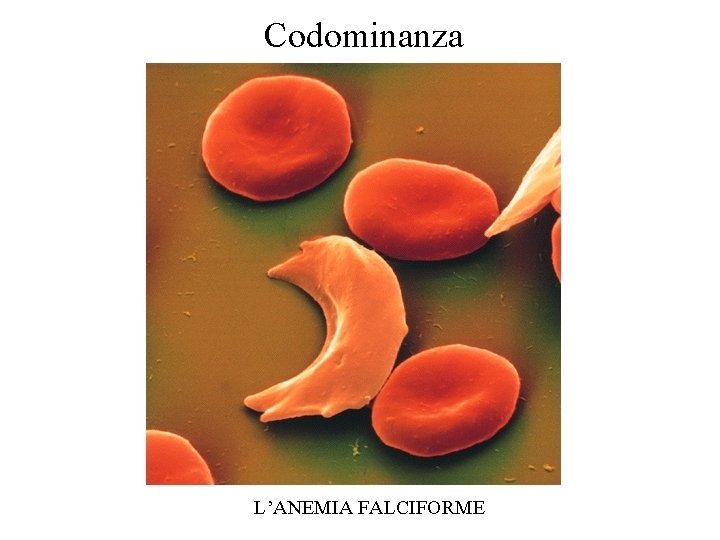 Codominanza L’ANEMIA FALCIFORME Codominanza L’ANEMIA FALCIFORME
