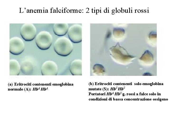 L’anemia falciforme: 2 tipi di globuli rossi (a) Eritrociti contenenti emoglobina normale (A): Hb. L’anemia falciforme: 2 tipi di globuli rossi (a) Eritrociti contenenti emoglobina normale (A): Hb.