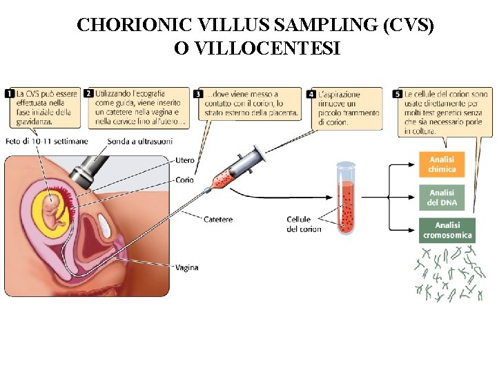 CHORIONIC VILLUS SAMPLING (CVS) O VILLOCENTESI CHORIONIC VILLUS SAMPLING (CVS) O VILLOCENTESI