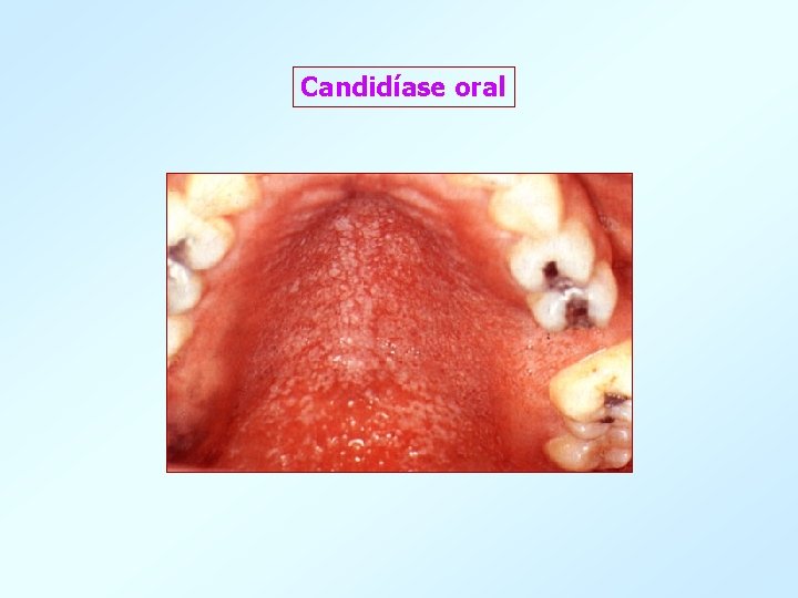 Candidíase oral 