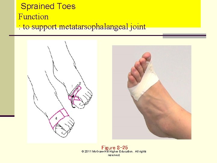 Sprained Toes Function : to support metatarsophalangeal joint Figure 8 -25 © 2011 Mc.