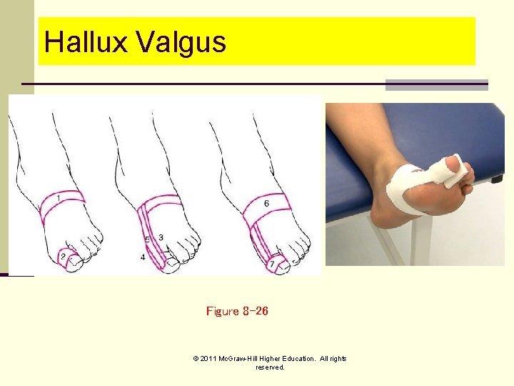 Hallux Valgus Figure 8 -26 © 2011 Mc. Graw-Hill Higher Education. All rights reserved.