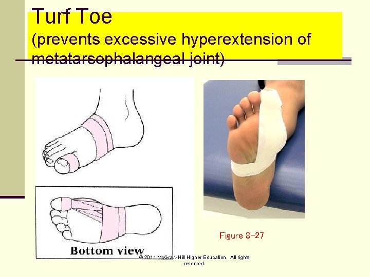 Turf Toe (prevents excessive hyperextension of metatarsophalangeal joint) Figure 8 -27 © 2011 Mc.