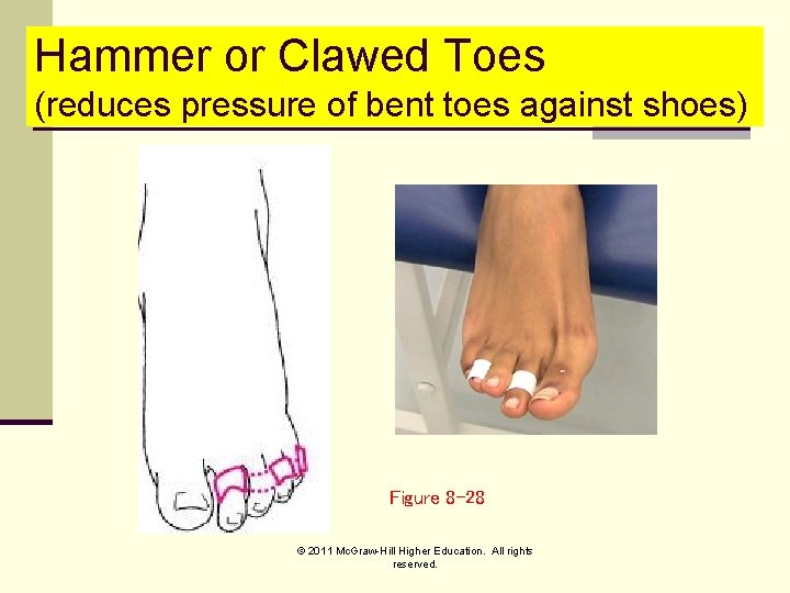 Hammer or Clawed Toes (reduces pressure of bent toes against shoes) Figure 8 -28