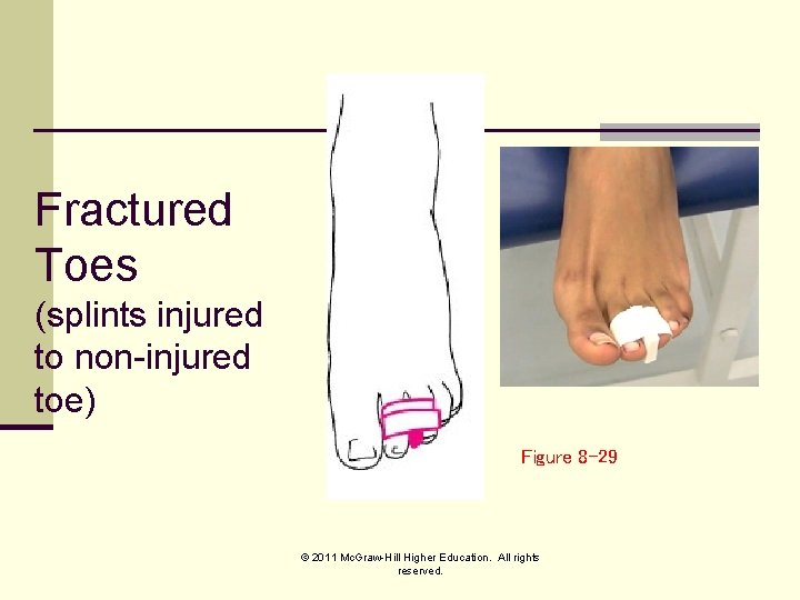 Fractured Toes (splints injured to non-injured toe) Figure 8 -29 © 2011 Mc. Graw-Hill